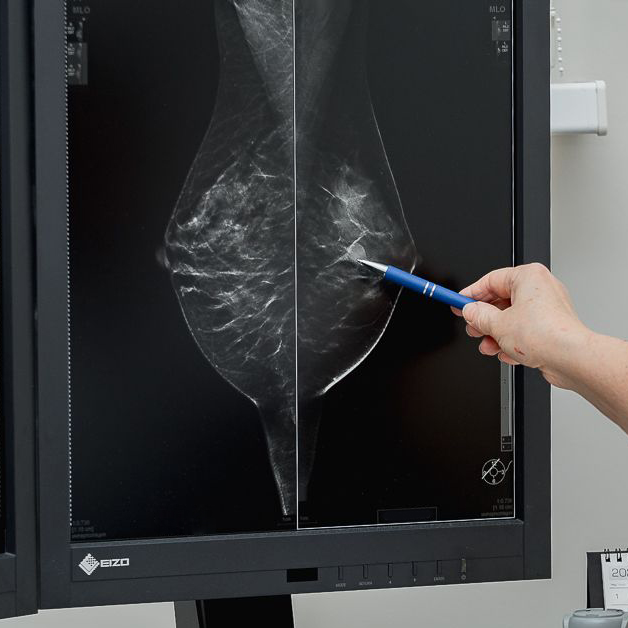 Маммография: почему нужна после 50-ти и чем отличается от УЗИ молочной железы?