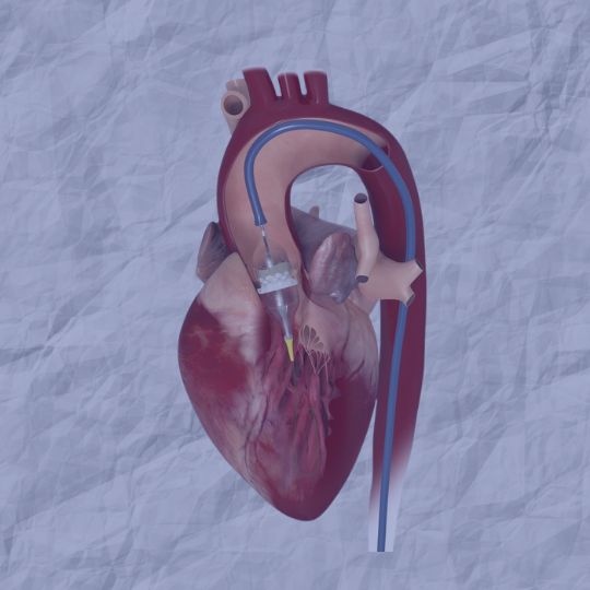 TAVI: когда операция на открытом сердце противопоказана