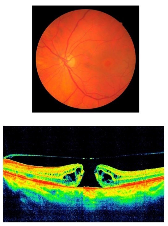 Сенильный макулярный разрыв