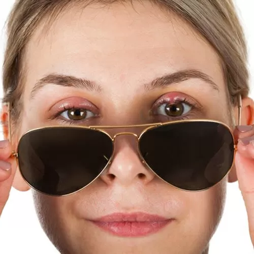 Хирургическое лечение халязиона