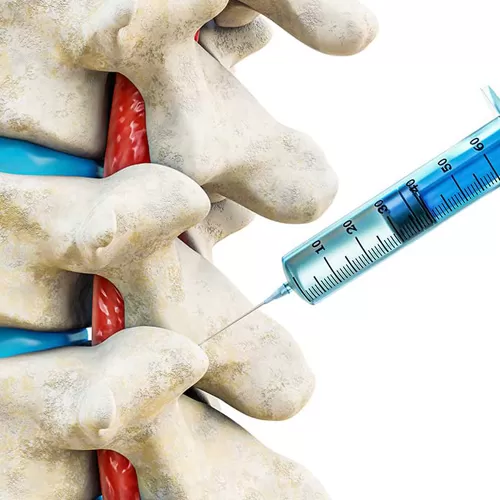 Современное интервенционное лечение боли в спине для повышения качества жизни пациентов