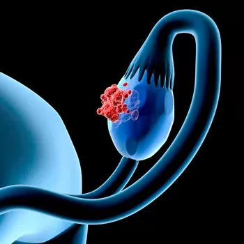 Онкогинекология